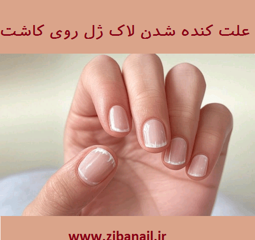 علت کنده شدن لاک ژل روی کاشت