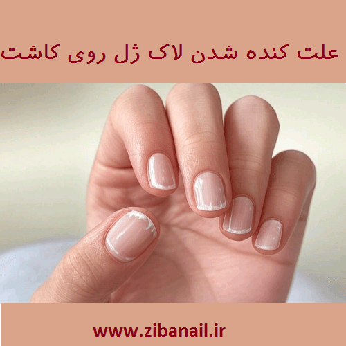 علت کنده شدن لاک ژل روی کاشت